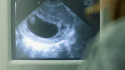 24692_in_ultrasound.